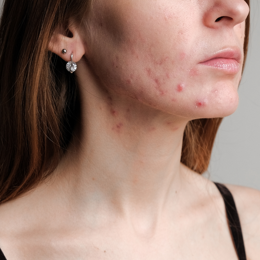 Acne & Breakouts