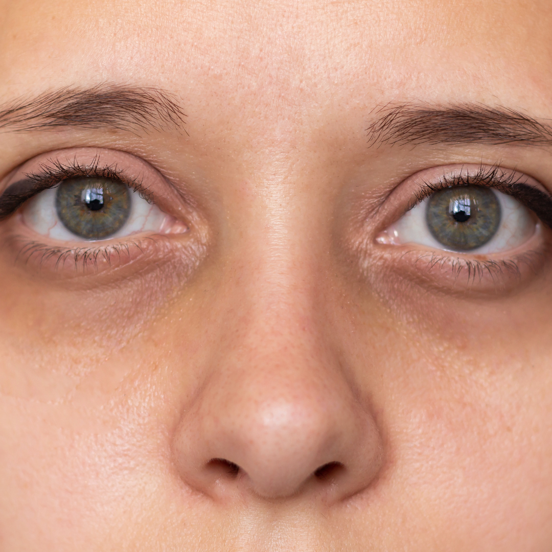 Dark Circles & Puffiness