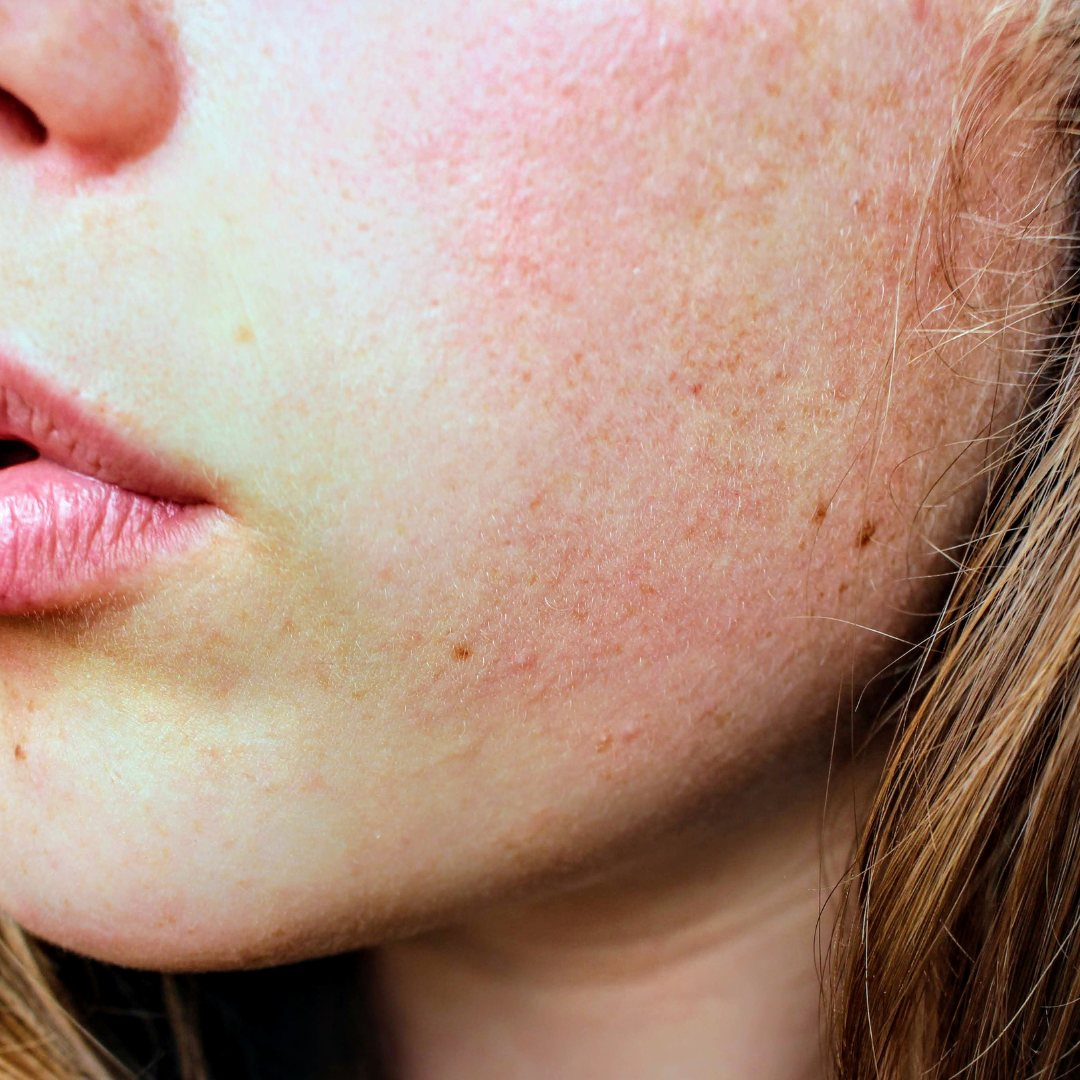 Eczema & Rosacea