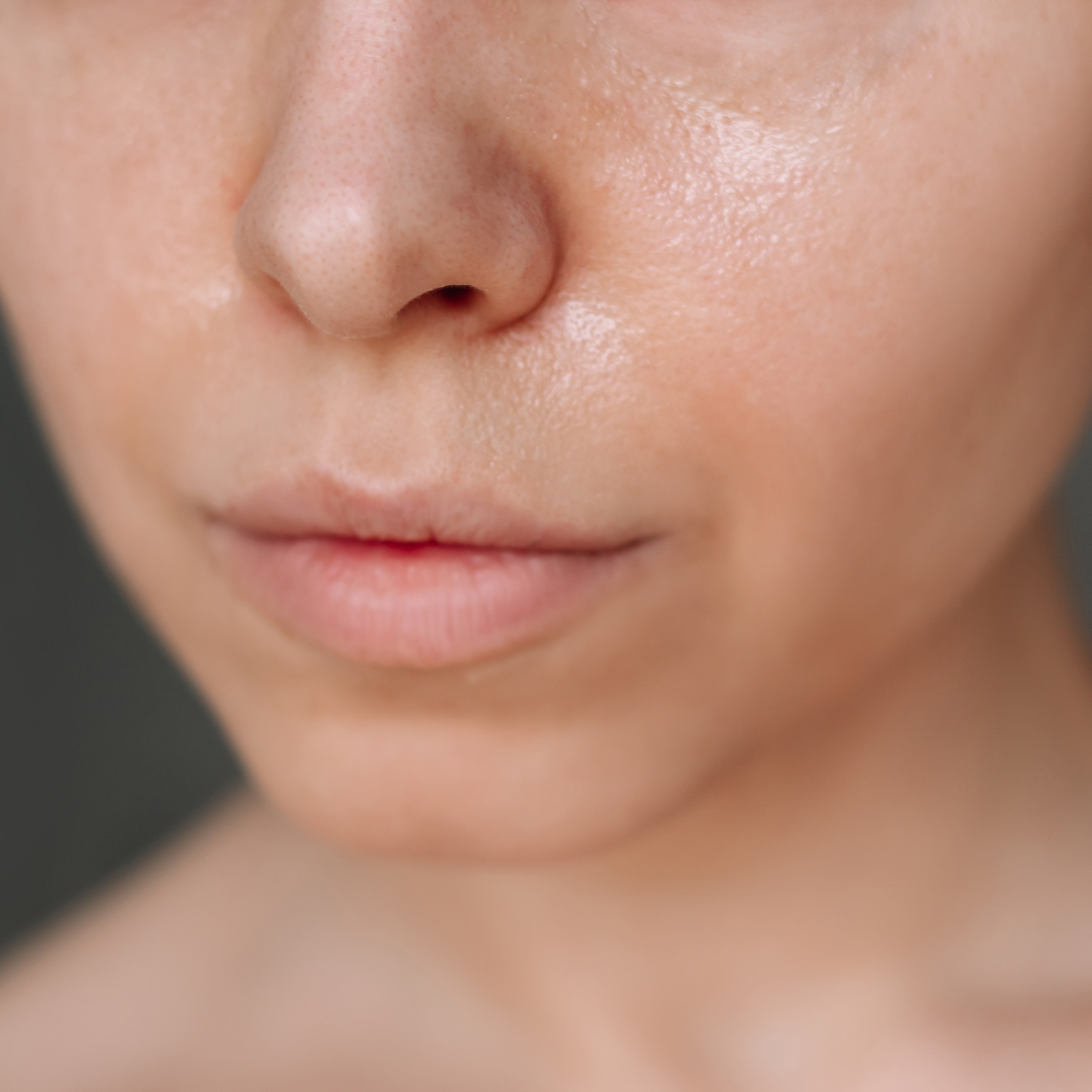 Excess Oil & Visible Pores