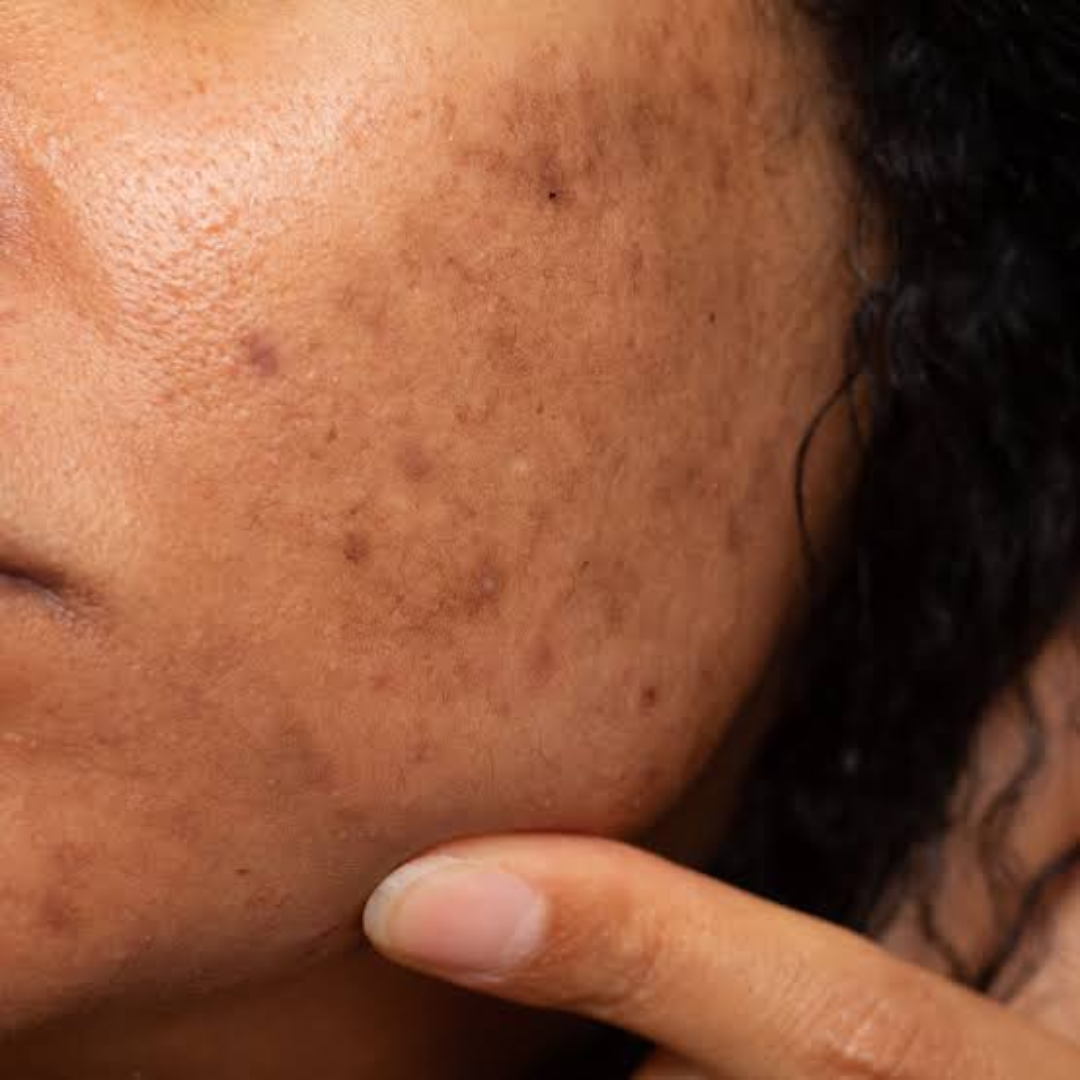 Dark Spots & Uneven Tone