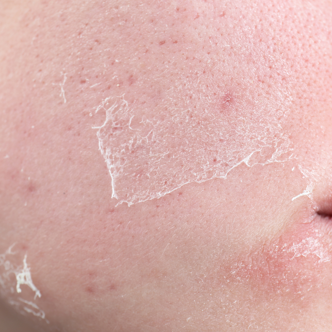 Dryness, Sensitivity & Redness